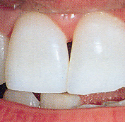 Das Ergebnis nach dem Bleichen stark verfärbter Zähne bei leicht geöffnetem Mund.