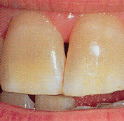 Zwei ungleichmäßig stark verfärbte Zähne bei leicht geöffnetem Mund.