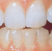 Gleichmäßig weiße Zähne nach dem Bleichen in Unter- und Oberkiefer.