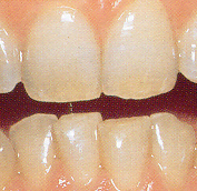 Sechs gleichmäßig verfärbte Zähne im Unter- und Oberkiefer vor dem Bleichen.