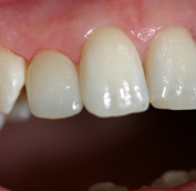 Der zweite Zahn von links mit Veneer unterscheidet sich optisch nicht von den angrenzenden natürlichen Zähnen.