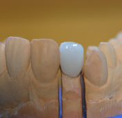 Ein Veneer innerhalb der Zahnreihe auf einem zahntechnischen Gipsmodell platziert.